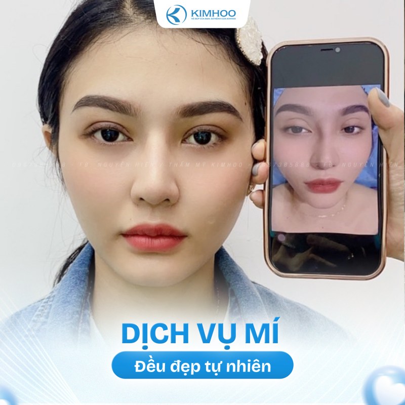 Kết quả 1 – PTTM Mí mắt