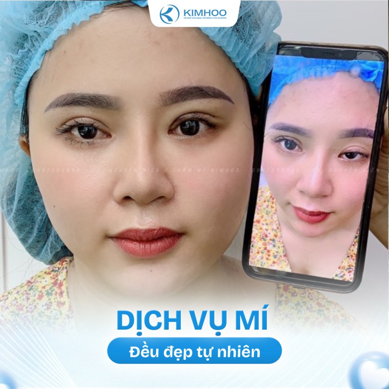 Kết quả 2 – PTTM Mí mắt