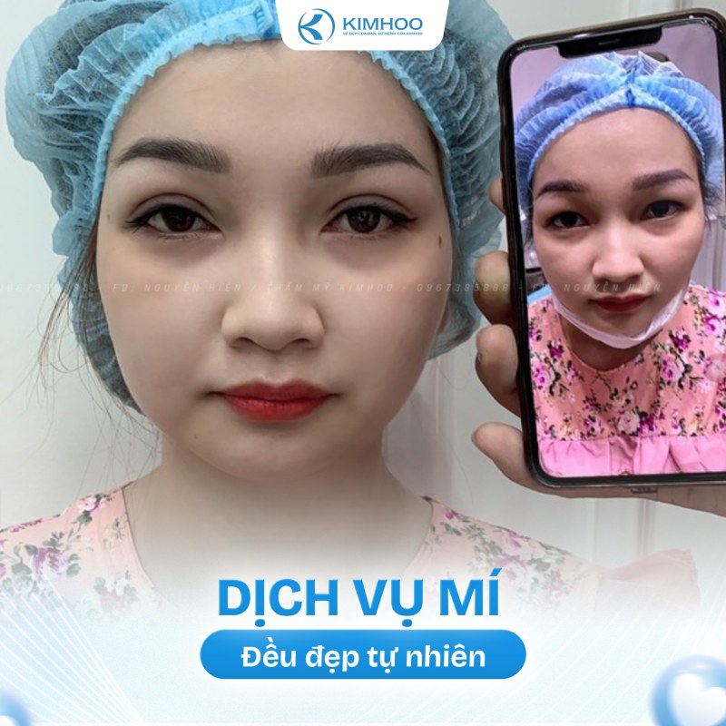 Kết quả 4 – PTTM Mí mắt