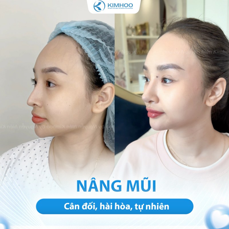 Kết quả 9 – Nâng Mũi