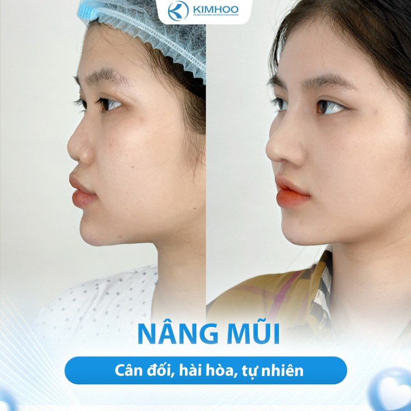 Kết quả 8 – Nâng Mũi