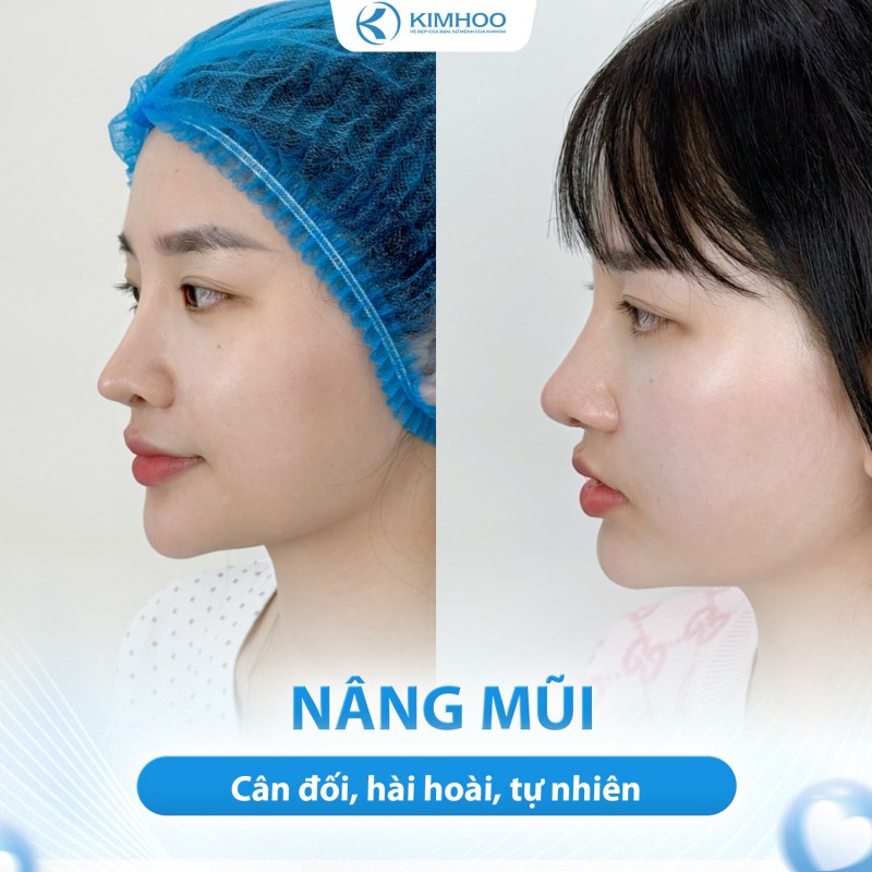 Kết quả 10 – Nâng Mũi