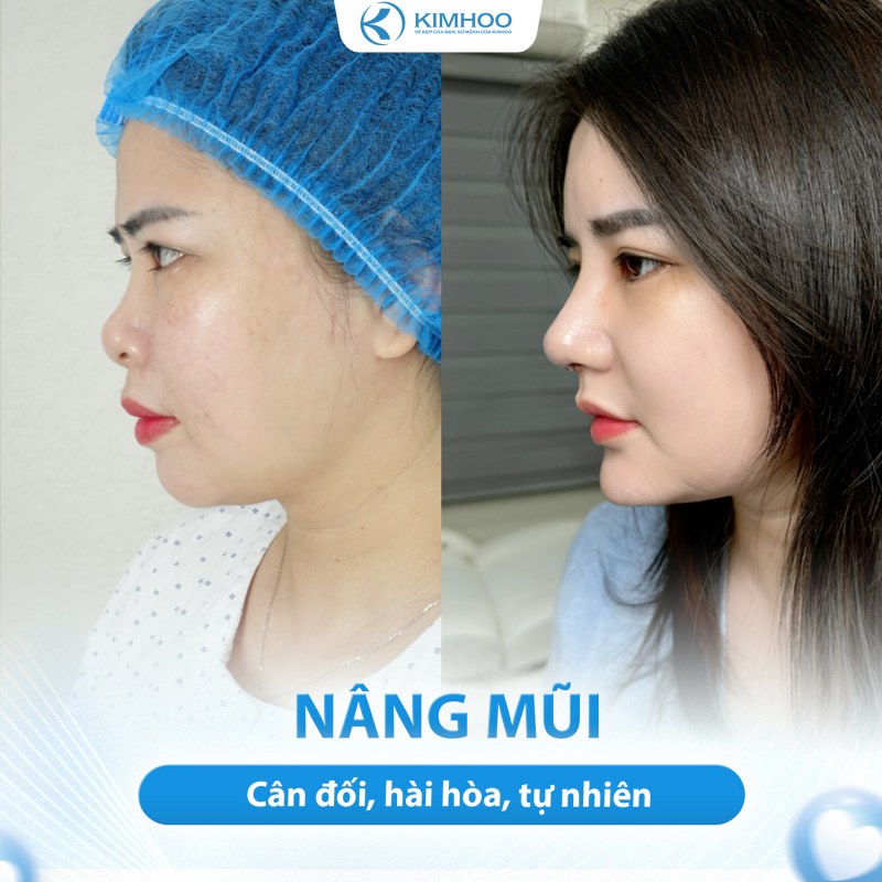Kết quả 7 – Nâng Mũi