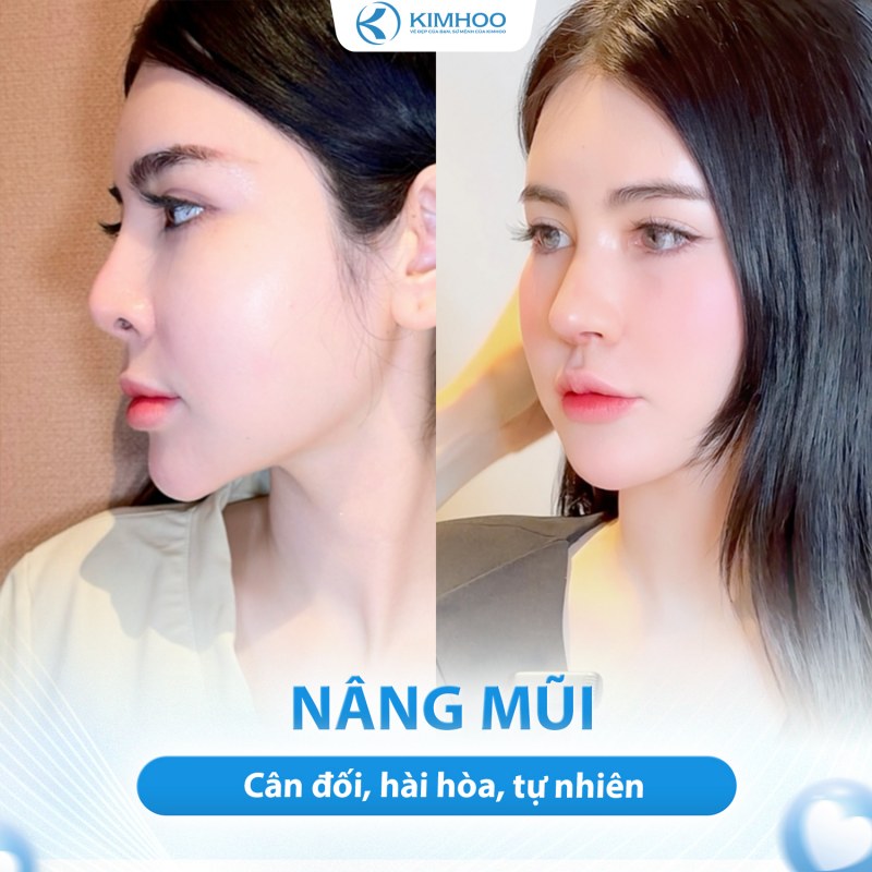 Kết quả 3 – Nâng Mũi