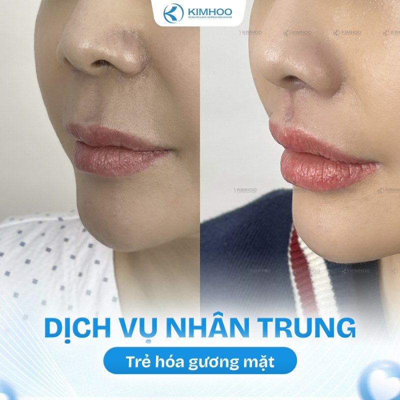 Kết quả 2 – Nhân Trung