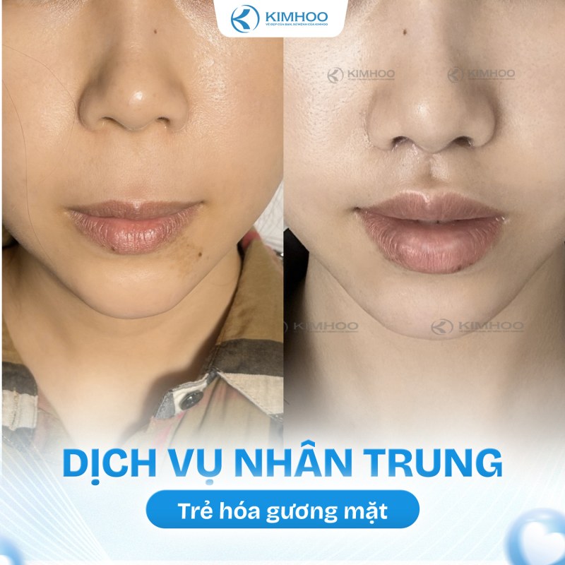 Kết quả 1 – Nhân Trung