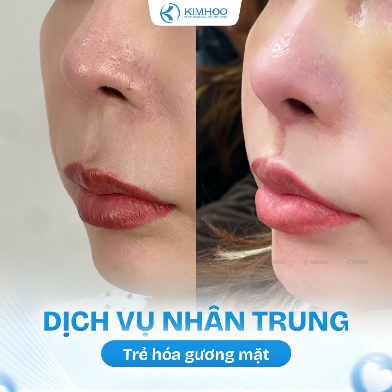 Kết quả 5 – Nhân Trung