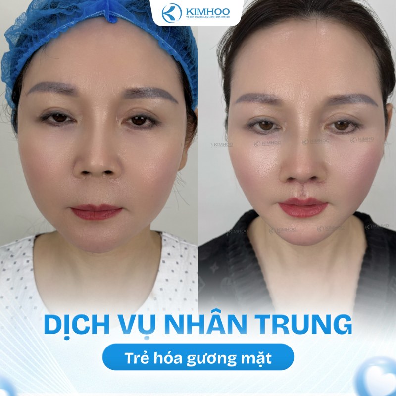 Kết quả 4 – Nhân Trung