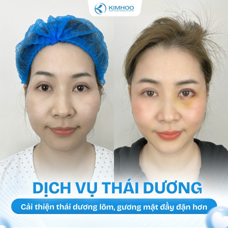 Kết quả 6 – Độn Thái Dương