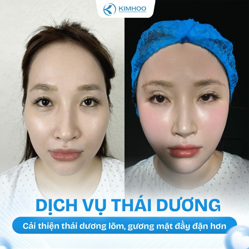 Kết quả 5 – Độn Thái Dương