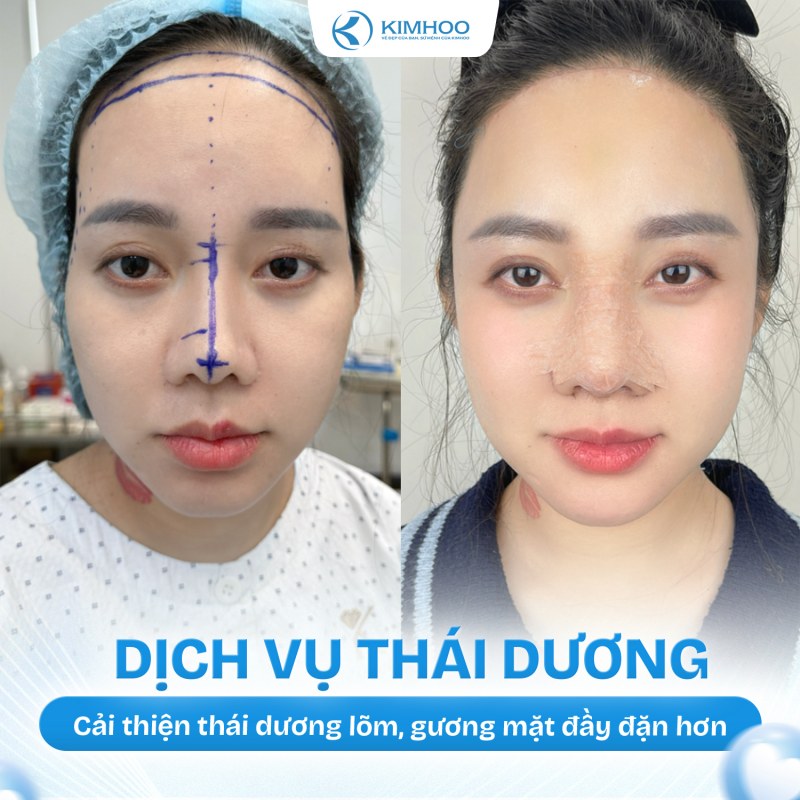 Kết quả 1 – Độn Thái Dương